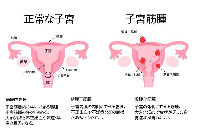 子宮内膜症 子宮筋腫とは 子宮に効くおすすめツボ 大阪市あかり治療 鍼灸院